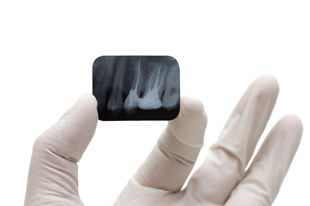 Radiographie-peri-apicale à la clinique dentaire Fréchette et Nadeau de Victoriaville.