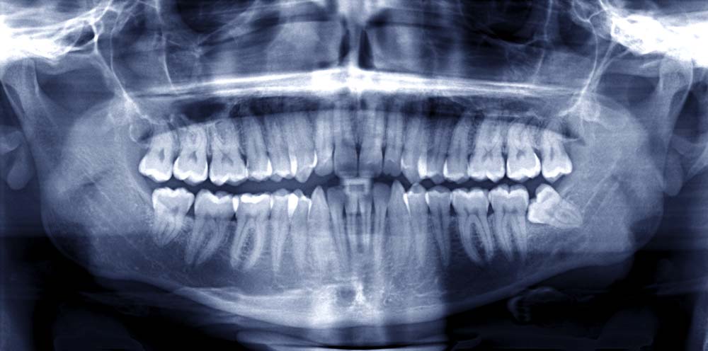 Radiographie rétro-coronaire à la clinique dentaire Fréchette et Nadeau de Victoriaville.